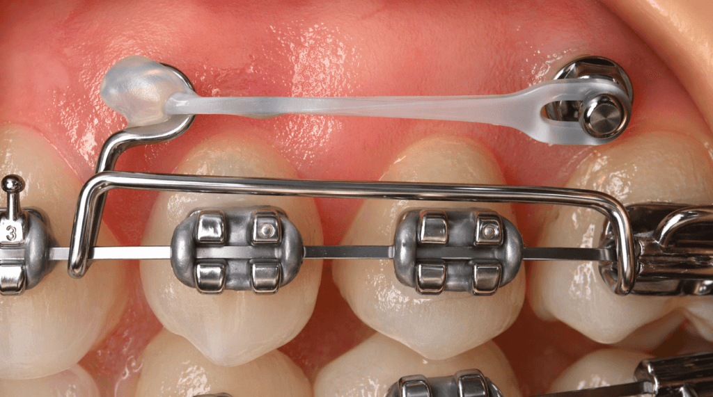 TADs-orthodontics-skeletal-anchorage