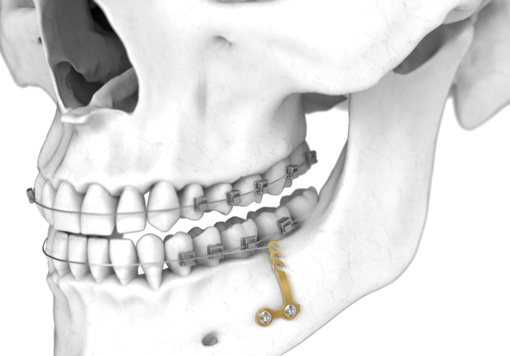 Dual Top_Skull_Anchor plate 3