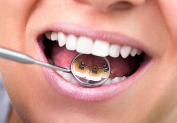 lingual-braces-chester lingual-braces-chester