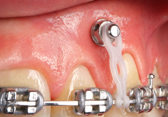 skeletal-anchorage-home